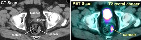 Colon And Rectal CT And PET Scans