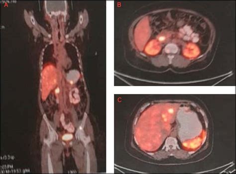 (A) Coronal section image of 68 Ga DOTATATE PET scan showing enhancing ...