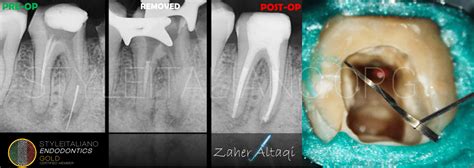 Management Of Broken Files A Clinical Approach Part 2 Style Italiano Endodontics