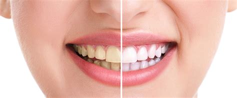 What Is The Difference Between Teeth Whitening Bleaching Dr