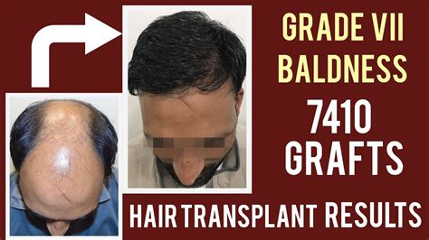 Grade 6 Baldness Hair Transplant 7000 Grafts Hair Transplant Results Hair Transplant Result