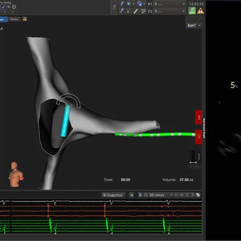 An Example Of The Transseptal Puncture Guided By High Density Mapping