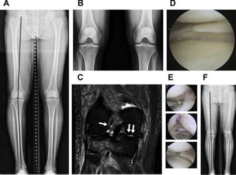 Role Of Alignment And Osteotomy In Meniscal Injuries Musculoskeletal Key