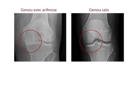 L arthrose du Genou symptômes et guérison Pôle ReyActive Morestel