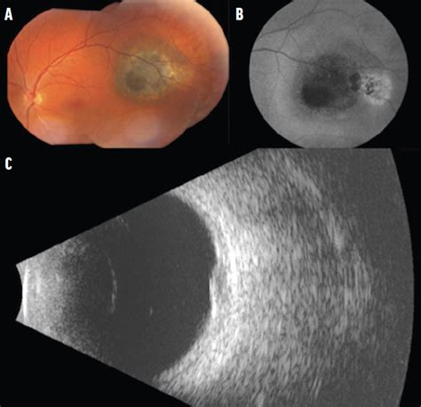 Hemorrhage Over A Choroidal Nevusharmless Or Hazardous Retina Today