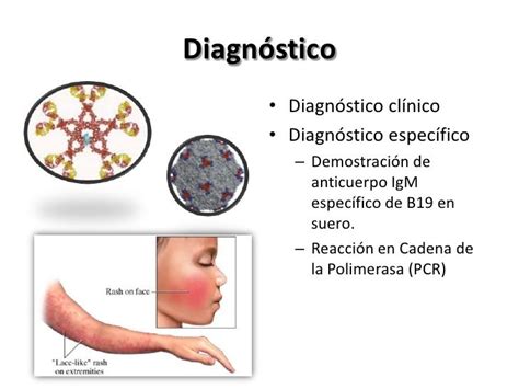 Parvovirus