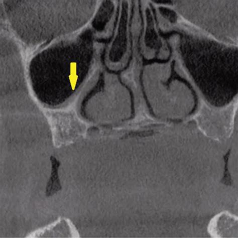 A Sagittal Cbct Section Showing Presence Of A Small Partial Septation