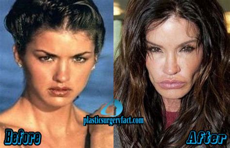 Too Much Plastic Surgery Before And After Worst Celebrity Plastic Surgery