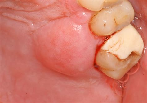 Absceso dental Qué es causas y tratamiento BQDC