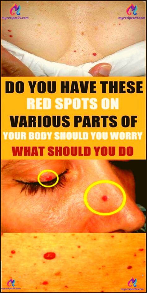 Do You Have These Red Spots On Various Parts Of Your Body Must See