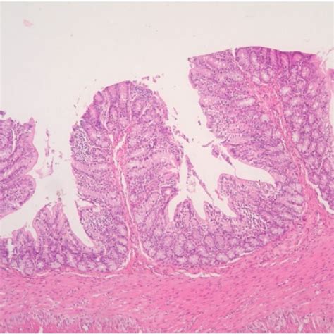 Gastrointestinal Mucosa Was Seen With The Secondary Cyst Formation Download Scientific Diagram