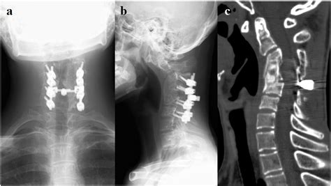 Severe Cervical Kyphosis In Adolescent After Minor Trauma A Case Report