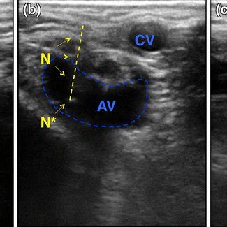 Axillary vasculature by real-time ultrasound. a Cross-sectional view of ...