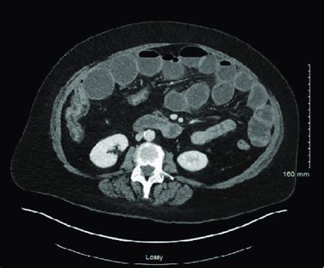 Ct Enterography Shows Isolated Crohn S Ileal Stricture With Persistent