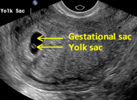 Normal first trimester 6 weeks ultrasound. - Ultrasoundfeminsider