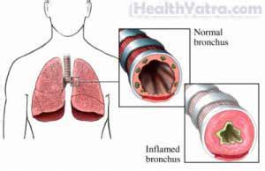 Berylliosis Definition, Causes, Symptoms, Complications and Cost ...