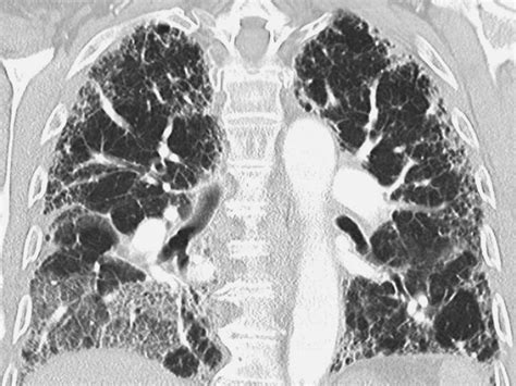 Idiopathic Pulmonary Fibrosis New Guidelines Released