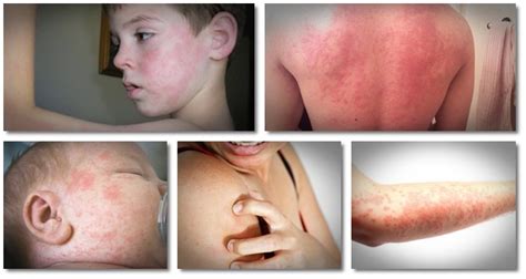 Chronic Hives Treatment How “get Rid Of Hives” Helps Sufferers Stop