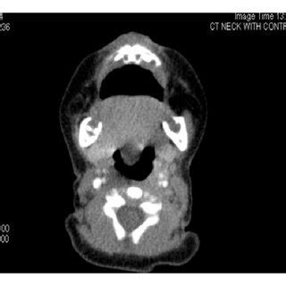 Flexible upper endoscopy showing a vallecular cyst obstructing the ...