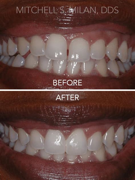 Before Uneven Teeth Gums After Corrected With Laser Gum Contouring