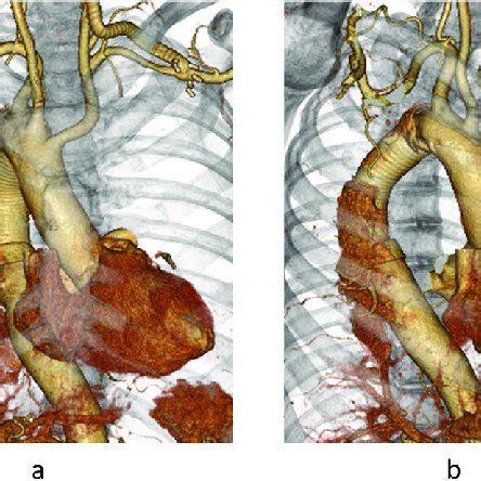 First Step (de-branching): Carotid-subclavian artery bypass on the left ...