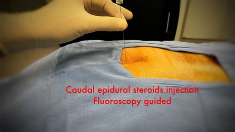 Caudal Epidural Steroids Injection Fluoroscopy Step By Step Youtube