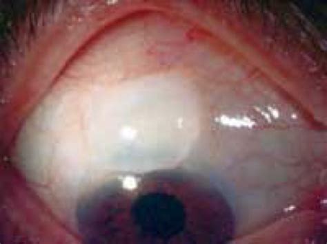 Glaucoma Surgery | Dr Rob Piemontesi