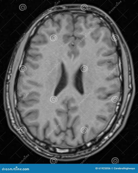 MRI Brain Axial View stock photo. Image of slice, human - 61925056