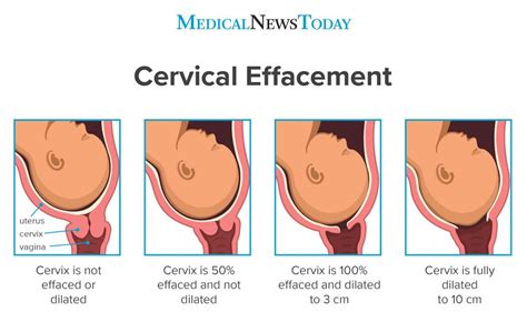 10 Cm Cervix Dilation