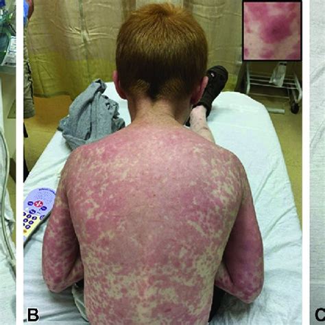 Clinical Appearance Of Urticaria Multiforme Like Drug Eruption In Our