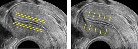 Uterine Contractile Activity In Healthy Women Throughout The Menstrual