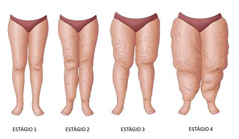 Lipedema O Que Saiba Quais Os Sintomas E O Tratamento Erick Bragato