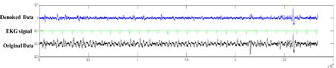 Raw LFP signals of the second patient at certain depth before and after ... 