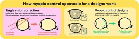 Myopia Control Visual Answers