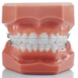 Chic Ceramic Roth Maxillary Gc Orthodontics Inc