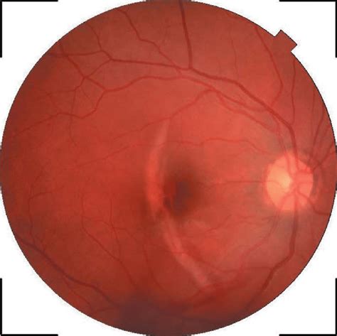 Fundus Photo Of The Right Eye March 2018 Download Scientific Diagram