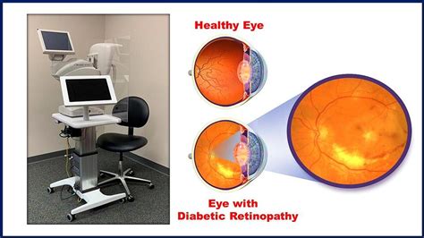 Research Story Tip Adult Proven ‘smart’ Diagnostic Tool For Diabetic Retinopathy Also Works For