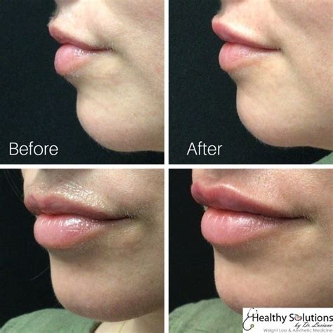 Lip Injections Before And After Photos Healthy Solutions Medspa