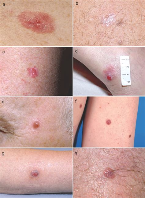 Dermatoscopy Of Amelanotic And Hypomelanotic Melanoma Stojkovic