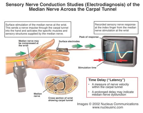 Emg Electromiograma Intermedica