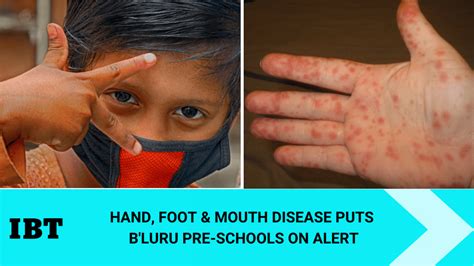 What Is Hand Foot Mouth Disease Bengaluru Pre Schools On Alert Amid