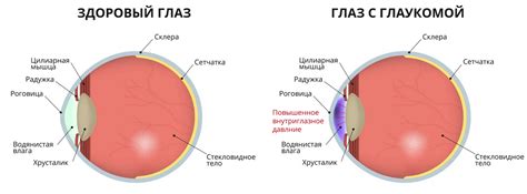 Интересные факты о Глаукома глаза что это