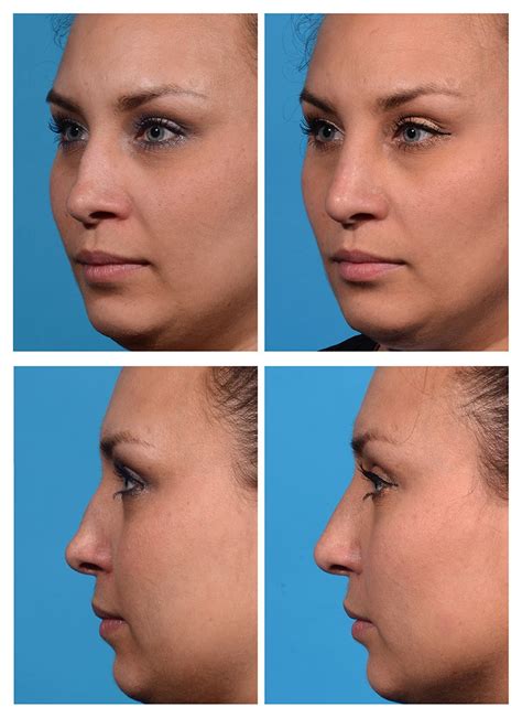 Revision Rhinoplasty Before And After Photos