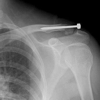 A. 20-year-old female with distal clavicular fracture. Zanca view... | Download Scientific Diagram