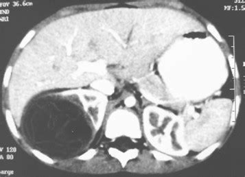 Tdm Abdominale En Coupe Axiale Avec Injection De Pdc Masse Kystique