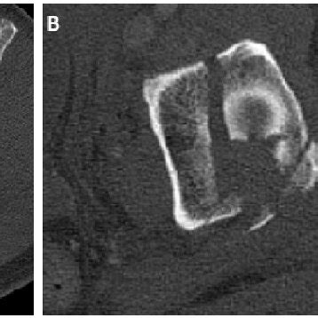 Initial Antero-Posterior (AP) pelvic radiograph showing pelvic ring... | Download Scientific Diagram