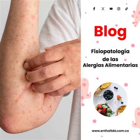 Fisiopatología De Las Alergias Alimentarias Entha