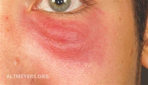 Borrelial Lymphocytoma On Cheek