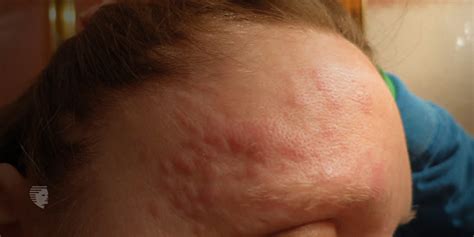 Hiv Rash On Scalp