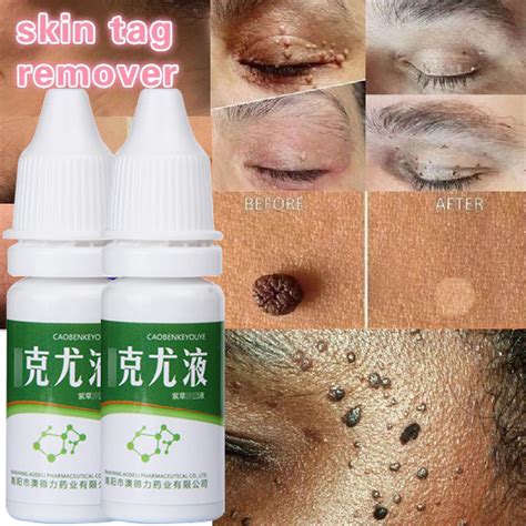 Warts Remover And Mole Remover Pure Organic Effective Original Kasoy